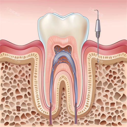 牙齿根管治疗漫画示意图 牙齿根管治疗漫画示意图