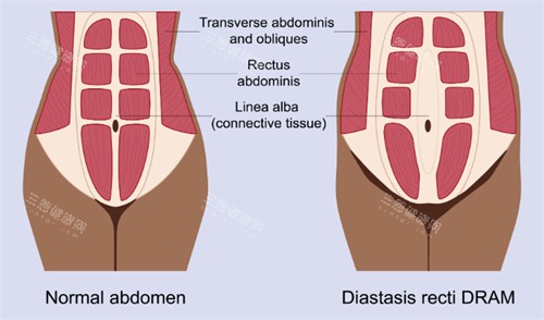 腹壁成形改善腹直肌 腹壁成形改善腹直肌