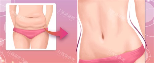 腹壁成形手术前后对比图 腹壁成形手术前后对比图