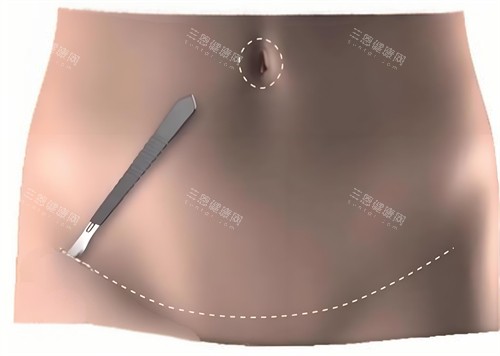 腹壁成形 腹壁成形