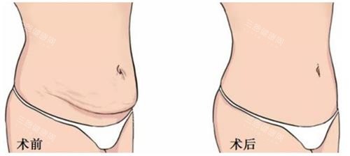 美人鱼腹壁成形手术前后的区别 美人鱼腹壁成形手术前后的区别