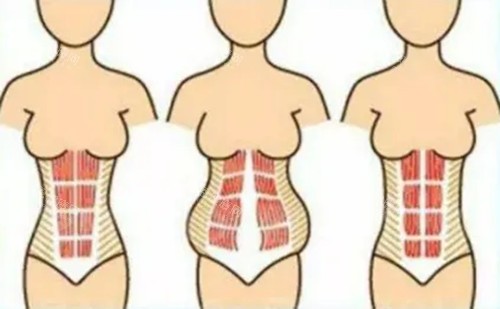 腹壁成形手术卡通示意图 腹壁成形手术卡通示意图