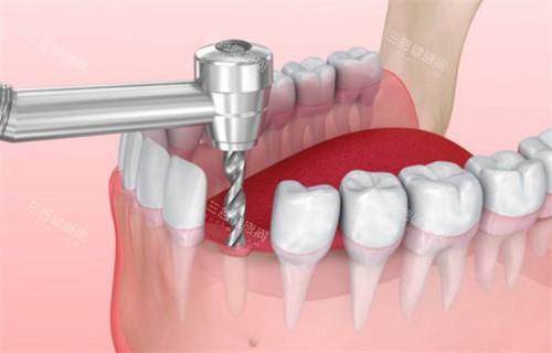 赣州种植牙选哪家？2026正规医院名单出炉，十家机构资质+种牙优势详细解析