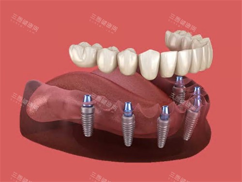 半口种植牙动画示意图展示