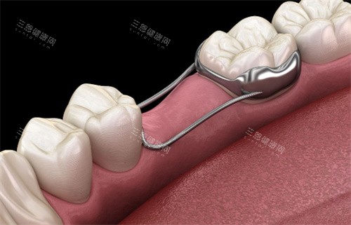 牙齿间隙保持器