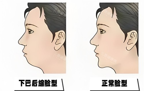 珠海下巴后缩矫正多少钱？玻尿酸3000起、截骨2.4w起、膨体植入1.5w起，附正规医院名单