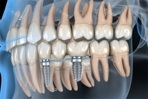种牙图示 种牙图示