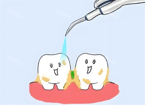 洗牙卡通示意图片 洗牙卡通示意图片