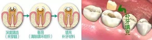 补牙过程展示