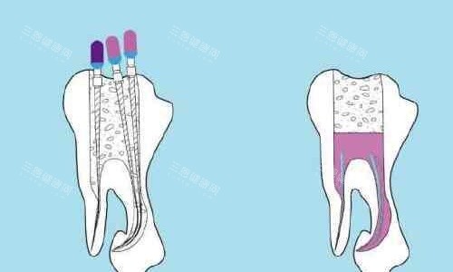 根管治疗手术示意图 根管治疗手术示意图