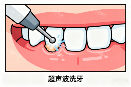 超声波洗牙卡通图 超声波洗牙卡通图