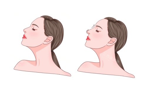 鼻整形术后示意图