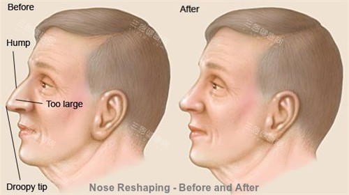 正常鼻子和过长的鼻子矫正对比