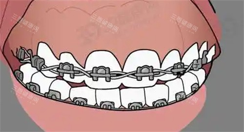 牙齿矫正动画图