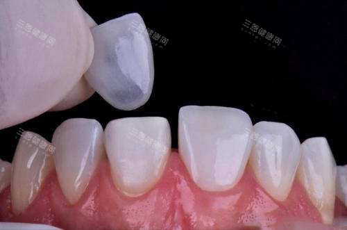 牙齿贴面过程 牙齿贴面过程