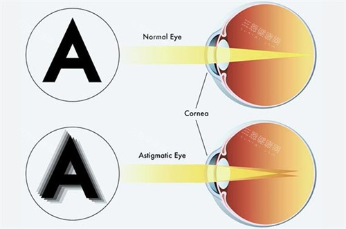 正常眼睛和弱视眼睛成像不同