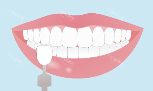 牙齿贴面示意图