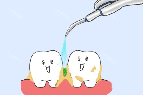 牙齿清洁展示图