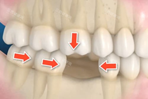 牙齿缺一颗不补的影响图