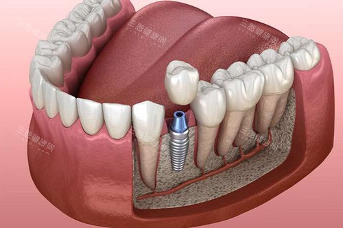单颗种植牙解刨图 单颗种植牙解刨图