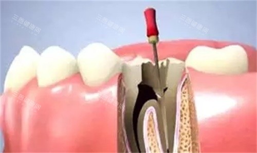 根管治疗4000元贵吗？多维度解析根管治疗费用影响因素与合理区间