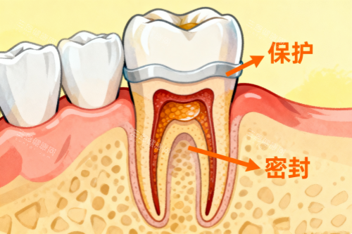 根管治疗卡通展示图