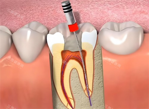 根管治疗动画展示