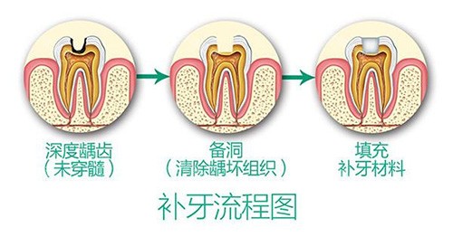 牙齿现针眼小洞补还是不补？医师揭秘背后的科学真相！