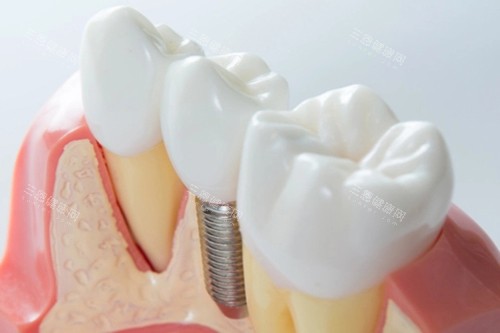 想了解奥齿泰有几个档次？各系列特点价格大公开，助你种牙不纠结！