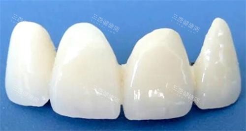国产美晶瓷全瓷牙