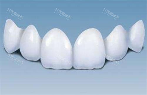 全瓷牙的示意图