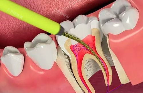 真相揭秘：牙髓还活着时，根管治疗到底该不该做？看完不再纠结！