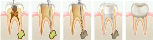 根管治疗步骤图