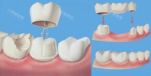 假牙带牙冠过程示意图 假牙带牙冠过程示意图