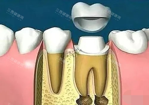 根管治疗后带牙冠 根管治疗后带牙冠