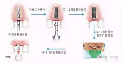 种植牙的6个步骤图解 种植牙的6个步骤图解
