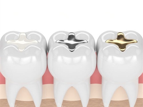 不同补牙材料成效漫画图 不同补牙材料成效漫画图