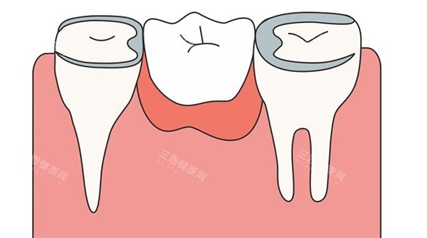缺牙补牙照片 缺牙补牙照片