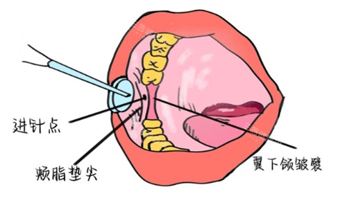 牙周韧带内注射麻醉 牙周韧带内注射麻醉