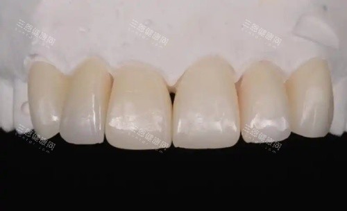 爱迪特全瓷牙示意图 爱迪特全瓷牙示意图