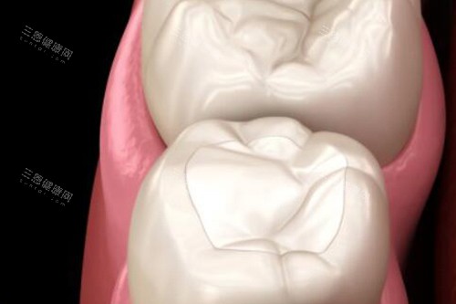 拔牙改善展示照片 拔牙改善展示照片