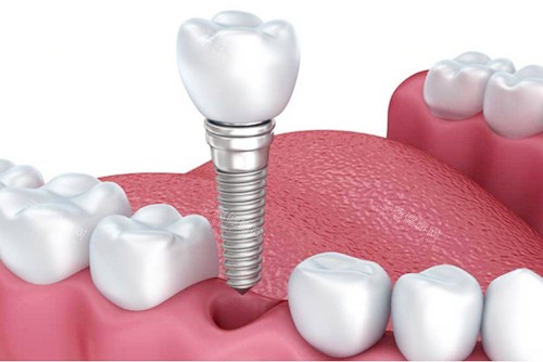 种植牙植入图 种植牙植入图