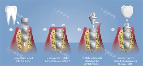 种植牙手术流程图 种植牙手术流程图