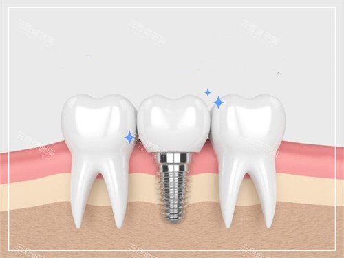 种植牙与真实牙齿漫画示意图 种植牙与真实牙齿漫画示意图