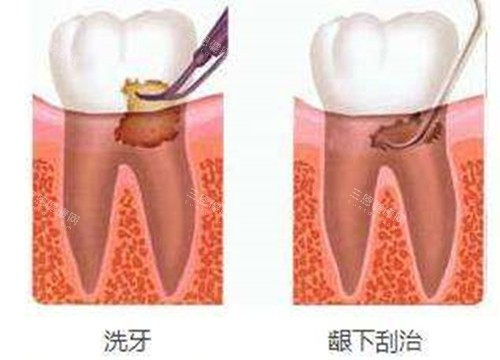 洗牙和龈下刮治对比示意图
