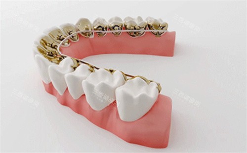 牙齿矫正模型 牙齿矫正模型