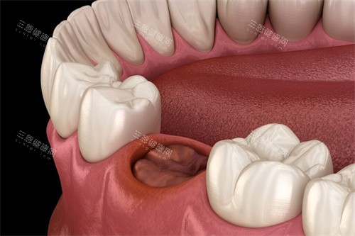 拔牙后牙窝 拔牙后牙窝