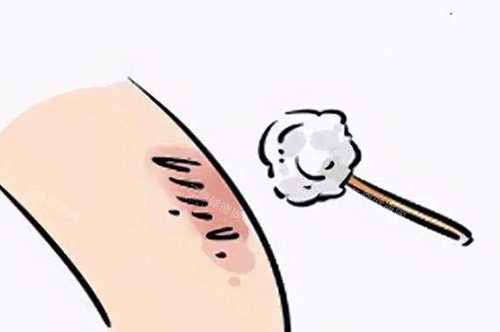 疤痕改善祛除卡通图 疤痕改善祛除卡通图