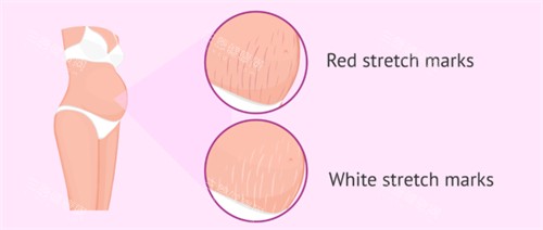 妊娠纹疤痕漫画图疤痕 妊娠纹疤痕漫画图疤痕