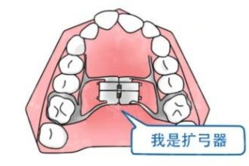 正畸扩弓示意图 正畸扩弓示意图